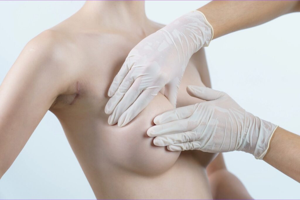 1. Aesthetic Breast Anatomy: Novel Insight for Improved Breast Implant  Design