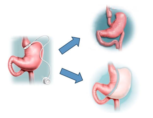 Gastric Revision